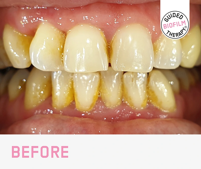  Guided Biofilm Therapy Certified Practice