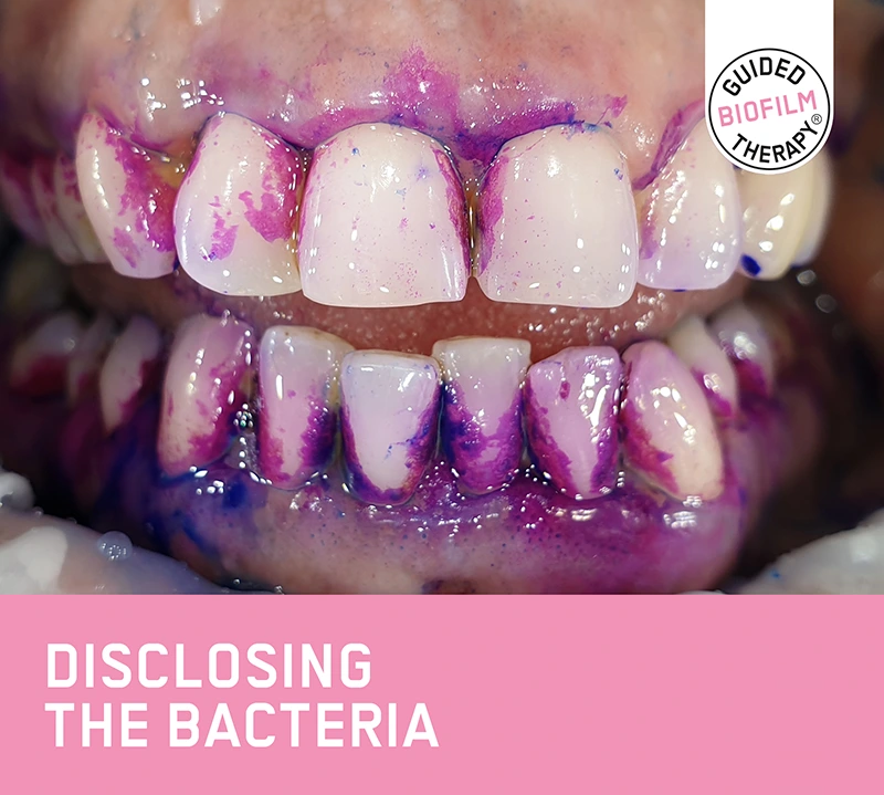  Guided Biofilm Therapy Certified Practice
